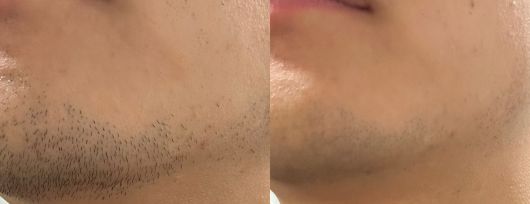 시리즈 9 프로 플러스를 사용하기 전(왼쪽)과 사용한 후. /김민국 기자