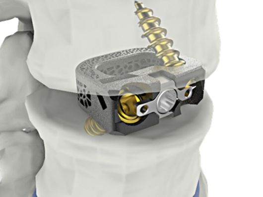 척추 융합기기 ‘유니스페이스(UniSpace)’. 시지메드텍 제공