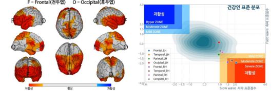 AI 뇌기능 검사 결과 예시 (자료=아이메디신)