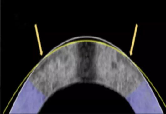전기기계적 재성형으로 각막이 평평하게 변형됐다. 원래 각막(흰색 선)과 성형 후 각막(노란색 선). 사진=Daniel Kim and Mimi Chen