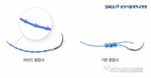 미늘(가시) 봉합사라 불리는 바브드 봉합사