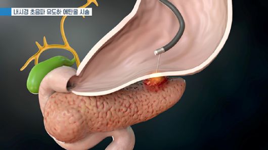 췌장염이 만성적으로 지속되면 췌장 기능 저하, 췌관협착 그리고 췌장관이 늘어나는 현상이 발생할 수 있다. [사진=EBS]