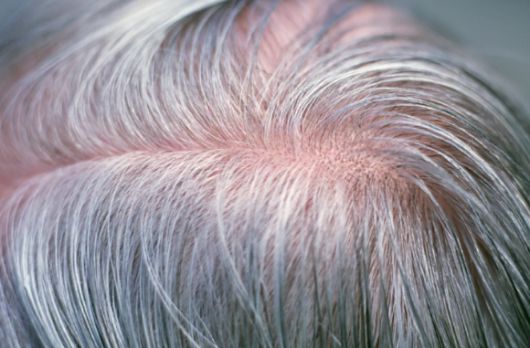 '흰머리'가 대사장애의 징후일 수 있다는 전문의의 설명이 공개됐다. 사진은 본 기사 내용과 무관. [사진=Science Photo Library]