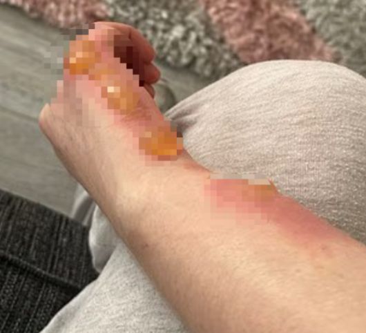 영국의 한 남성이 해당 식물을 만진 뒤, 손과 목에 발진이 생긴 채로 잠에서 깼다. 이후 그 발진은 '포도알 크기'의 물집으로 번졌다. [사진=데일리메일 캡처]