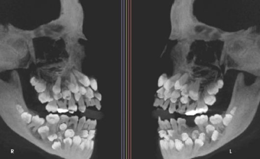 '치아 81개'를 가진 사례가 학계에 보고됐다. 사진은 소녀의 엑스레이. [사진=미국 치과교정·악안면외과학회지(AJO-DO)]