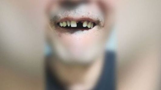 40대 택시기사가 지난 5일 20대 남성 승객에게 폭행을 당해 앞니가 부러졌다고 주장하며 공개한 사진. /사진=SBS 보도 캡쳐