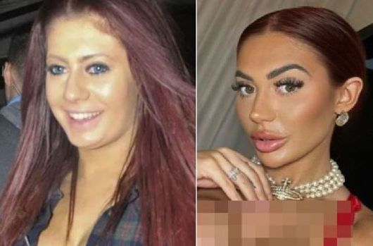 클로이 페리의 성형 전(왼쪽)과 후의 모습/사진=더 선