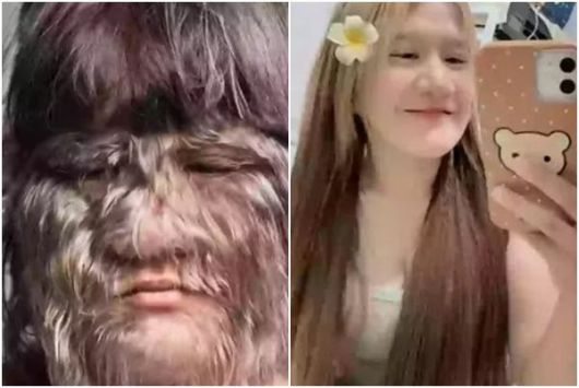 '늑대소녀'라 불리던 20대 태국 여성이 최근 털을 모두 없앤 근황이 화제다. 사진=SNS