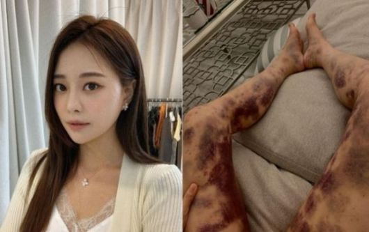 아옳이가 공개한 피멍 전신 사진. 사진ㅣ아옳이SNS