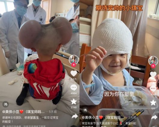 치바오 수술 전후 모습. 출처=더우인, 연합뉴스TV