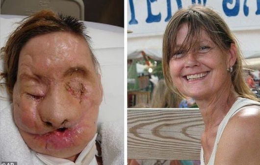 미국 코네티컷 주 스탬퍼드에서 살던 찰라 내시가 침팬지에게 공격 당해 얼굴을 잃은 찰라 내시가 안면 이식 수술을 받기 전(왼쪽)과 공격받기 전 원래 모습. 출처=데일리메일