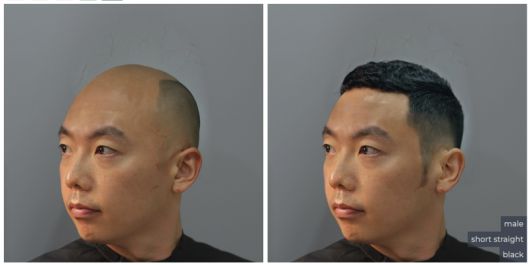 성별, 헤어스타일, 헤어컬러 등을 설정해 보다 구체적이고 사실적으로 모발 이식 결과를 예측하는 Hairgen.ai의 기술. 국내에서 모건피부과가 최초로 도입한다. 유한한 자원을 사용하는 모발 이식 수술 분야에서 환자의 불안을 줄이고 신뢰를 높이는 데 쓰일 예정. 2025년 7월 7일. 사진 제공=모건피부과의원