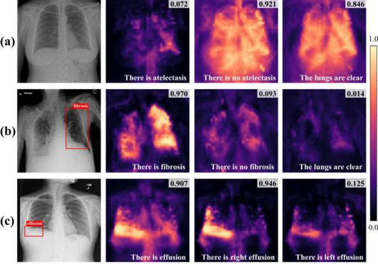 비전-언어 모델이 흉부 X-ray와 판독문의 관계를 학습 유사도를 확률값으로 표현한 모습. 딥노이드 제공.