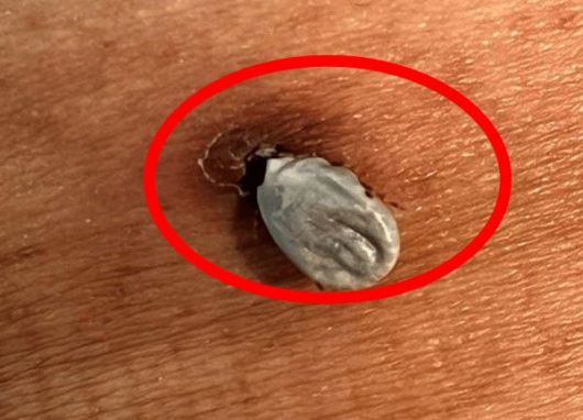 70세 남성 왼쪽 옆구리에 한 달간 붙어 있던 진드기./사진=큐레우스