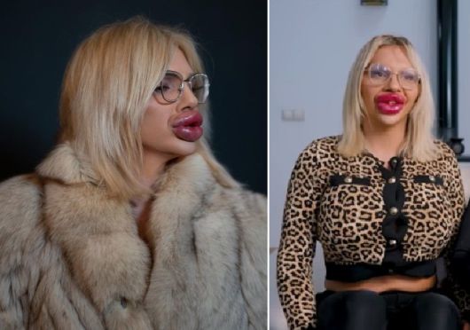 큰 입술을 가진 비엔나 뷔르스텔이 아이가 태어난 뒤 악플 때문에 괴롭다고 호소했다. 출처= 더 선