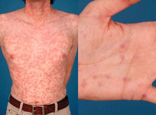 성관계 후 피부에 발진 증상이 지속된다면 매독을 한 번쯤 의심해야 한다./사진=캐나다 의학 협회지