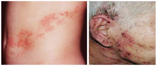 대상포진의 초기 증상은 신체의 한 쪽에서 나타나는 찌릿하거나 화끈거리는 통증이다. 보통 통증이 2~3일 정도 지속된 뒤 신경을 따라 띠 모양으로 발진이 나타난다. 사진=질병관리청·국민건강관리포털