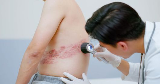 대상포진은 어린 시절 앓았던 수두 바이러스가 몸속 신경절에 잠복해 있다가 면역력이 떨어질 때 재활성화되면서 발생하는 질환이다. 띠 모양의 발진과 함께 극심한 통증이 동반되는 것이 특징이며, 50대 여성에게서 발병 가능성이 가장 높다. 사진=게티이미지뱅크