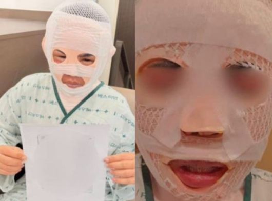 잠을 자고 있던 태국인 아내의 얼굴에 끓는 물을 부어 화상을 입힌 40대 한국인 남성이 경찰에 붙잡혔다. 이 남성은 아내가 다른 남성을 만나는 것이 두려워 이 같은 범행을 저질렀다고 주장했다.사진=SNS 캡처