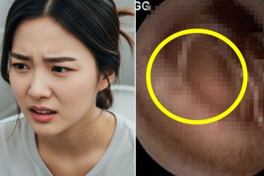 기사 이해를 돕기 위해 AI로 생성한 이미지(좌), 사례 여성의 소장에 기생충이 붙어있는 모습./사진=멕시코 위장병학회지(우)