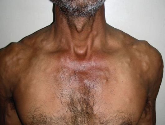 낭미충 감염으로 신체에 종양이 생긴 40대 남성의 모습./사진=인도 피부과 저널