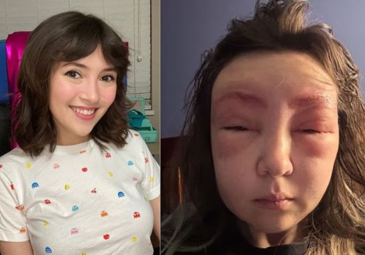 눈썹 염색 부작용으로 얼굴이 부어오른 여성. 출처=데일리메일