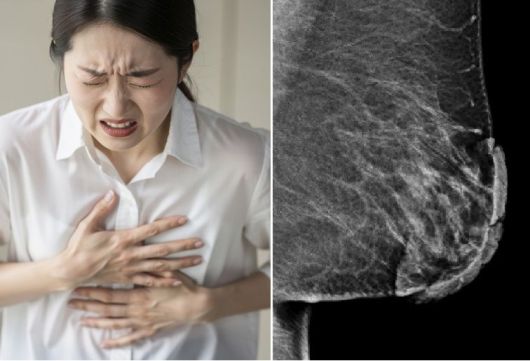 왼쪽 사진 유두-유륜 복합체의 피부가 두꺼워져 있다. 출처=큐레우스, 게티이미지뱅크