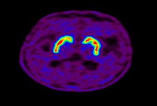정상인의 뇌 핵의학 영상(도파민 분비 부위 활성)