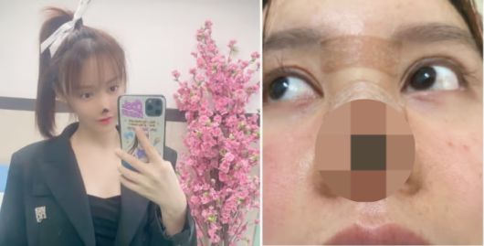 가오류가 공개한 성형 후 사진. [사진 = 가오류 웨이보]