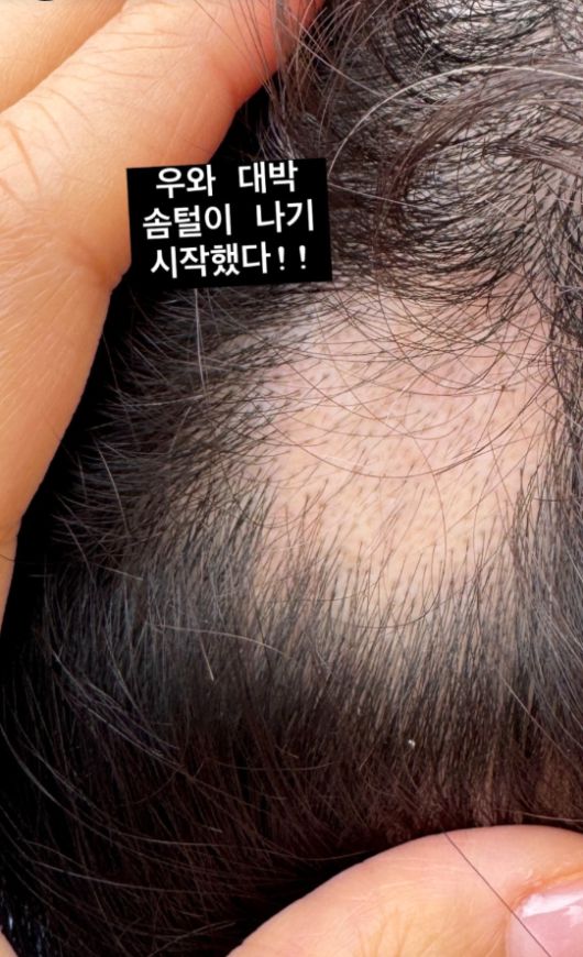 직접 촬영한 이 사진은 회복 중인 그 순간을 고스란히 보여주며 보는 이들의 응원을 이끌어냈다.사진=박성광 SNS