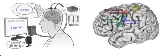 환자가 말하고 싶은 생각을 떠올리면, AI가 이를 읽어낸 뒤 음성으로 전환해 준다. [사진=네이처]