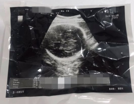 36주차 낙태 의혹이 불거진 영상 관련 태아 초음파 사진 캡처. 사진 인스타그램