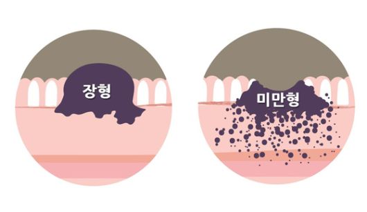 위암의 형태에 따른 분류, 미만형 위암은 점막을 따라 퍼지듯 분포되어 조기 발견이 어렵고 예후도 좋지 않다. 분당서울대병원