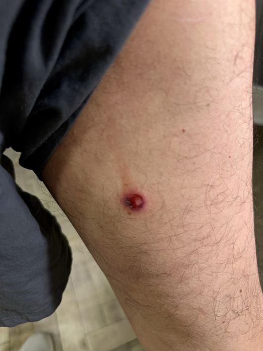 시위 취재 중 경찰의 고무탄 세 발을 맞은 장열 기자의 종아리 부위. 김상진 기자