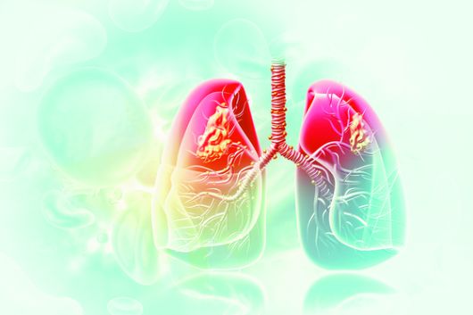 폐암 이미지. 케티이미지뱅크