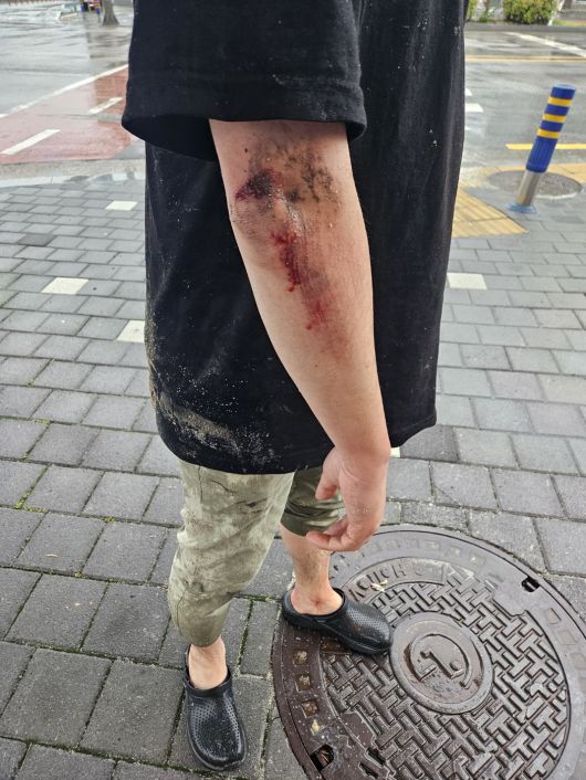 지난 21일 남원에서 발생한 땅 꺼짐(싱크홀) 사고로 다친 박모(46)씨. 인도가 2m 아래로 무너지면서 오른쪽 팔꿈치와 왼쪽 다리 피부가 벗겨지고 파여 피가 나고 있다. 사진 박씨