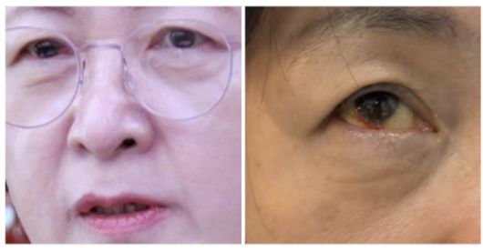 지난 3일 추미애 법제사법위원장이 페이스북을 통해 ″법사위 왼쪽 줄의 고성과 고함 지르기″라며 충혈된 눈 사진을 공개했다. 페이스북 캡처