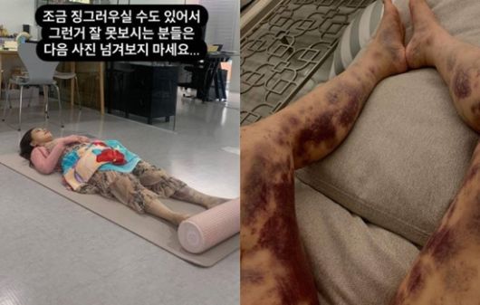 아옳이가 공개한 피멍 전신 사진. 사진ㅣ아옳이SNS