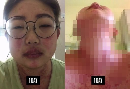 최준희가 공개한 과거 루프스 투병 시절 모습. 사진ㅣ최준희SNS