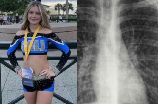 학교 치어리더로 활동했던 17세 딸이 치명적인 폐 질환에 걸렸다는 사실을 알게 된 어머니가 '전자담배'의 위험성을 경고했다. 8일 데일리메일 등 외신은 미국 네바다주에 사는 브리앤 컬런(17)은 4개월 전 치어리딩 연습 중 호흡곤란을 느껴 병원에 간 결과 일명 '팝콘 폐' 진단을 받았다고 보도했다. 데일리메일