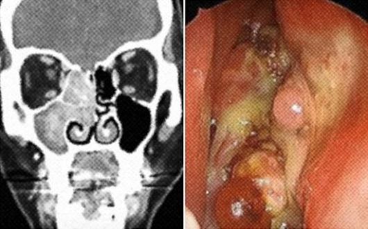 종양 사진. 서울아산병원