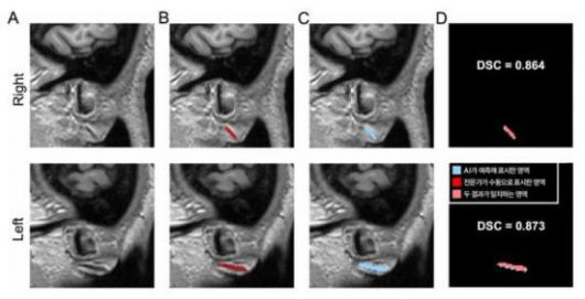3차원 원본 이미지(A)를 토대로 전문가가 수동으로 직접 표시한 주름(B)과 AI가 예측해 자동으로 표시한 영역(C). 분당서울대병원