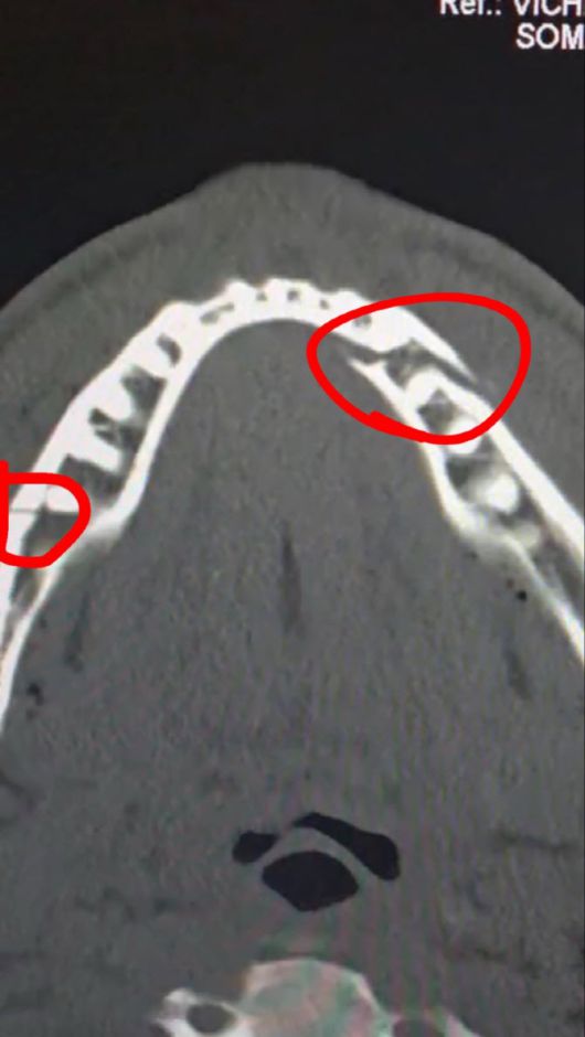 제이크 폴의 턱 엑스레이. 사진=제이크 폴 SNS