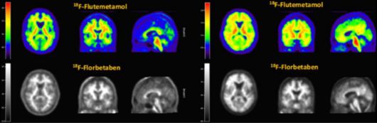 알츠하이머 치매 진단을 위해 쓰이는 '비자밀'(윗쪽 컬러 사진)과 '뉴라체크'(아랫쪽 흑백 사진) PET-CT 영상 비교 (자료=듀켐바이오)