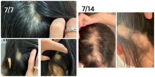 일본 20대 여성 A씨가 모더나 1차 접종 후 탈모 증상이 생겼다며 공개한 사진. 머리카락이 빠져 두피 곳곳이 드러난 모습이다./A씨 블로그