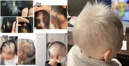지난해 7월 A씨가 공개했던 탈모 진행 상황. 오른쪽 백발의 모습은 올해 2월이다. /A씨 블로그