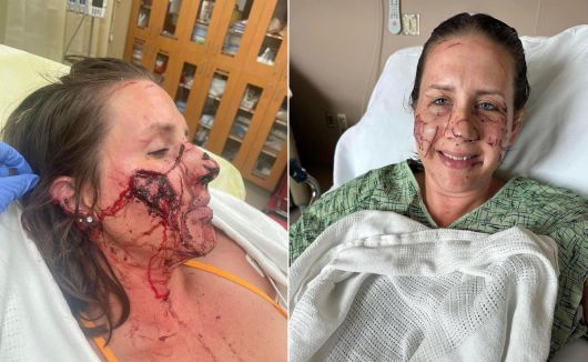 지난 2일(현지시각) 미국 몬태나주에서 물놀이를 하다 수달에게 공격을 받은 젠 로이스는 수술을 마치고 회복 중이다./페이스북