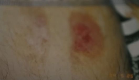 사건 이후 박한상의 종아리에서 발견된 교상. 물어 뜯긴 흔적이다. 치열 대조 결과 아버지의 것과 일치했다. /MBC 유튜브 영상