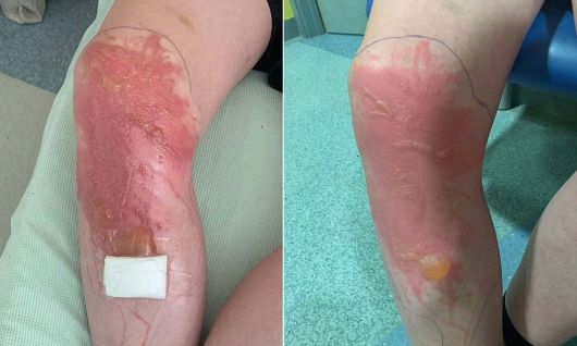 큰멧돼지풀에 스친 영국의 한 10대 소년 다리에 물집이 생긴 모습./데일리메일