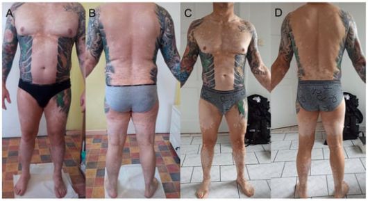 문신 시술 이후 이상 증세가 나타난 뒤로부터 2년 뒤(왼쪽에서 첫 번째, 두 번째 사진) 모습과 4년 뒤 모습(왼쪽에서 세 번째, 네 번째 사진)./의학 학술지 클리닉스 앤 프랙티스